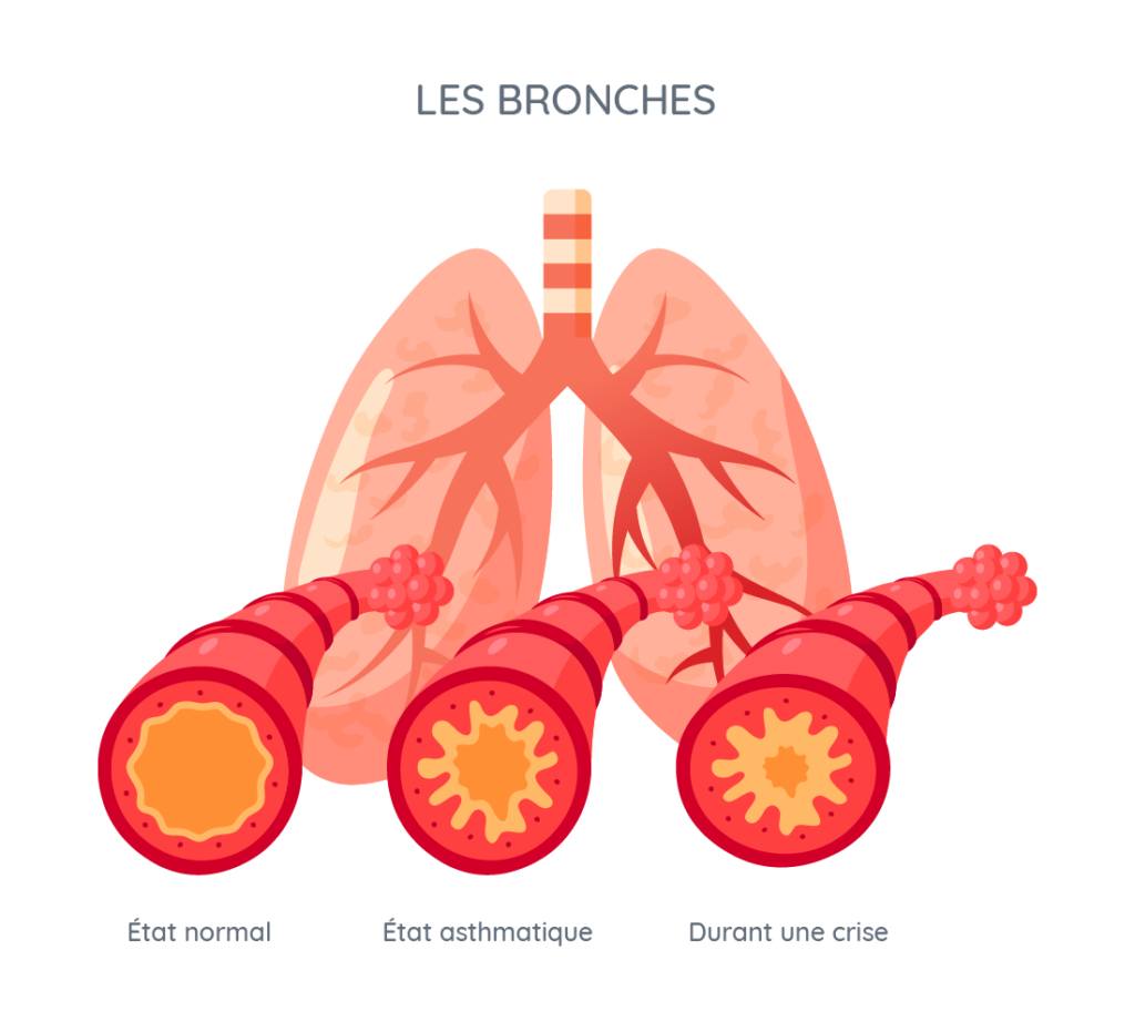 bronches pourmons asthme