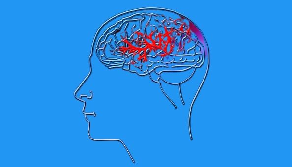 Accident Vasculaire Cérébral : tout ce que vous devez savoir
